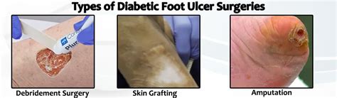 Diabetic Foot Ulcer Surgery Cost in Hyderabad - My Health Hospitals