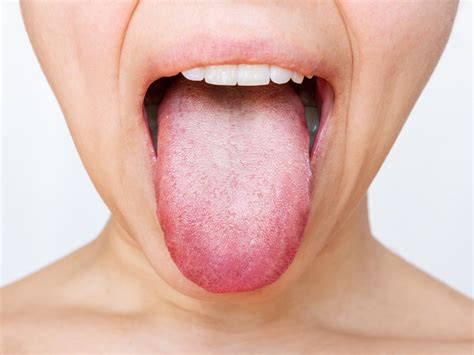 White Tongue: Symptoms, Causes And Treatment