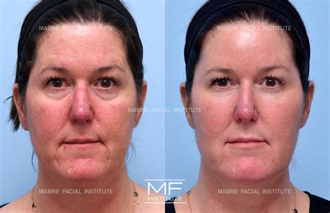 Complete Facial Rejuvenation or Contouring Before and After Pictures
