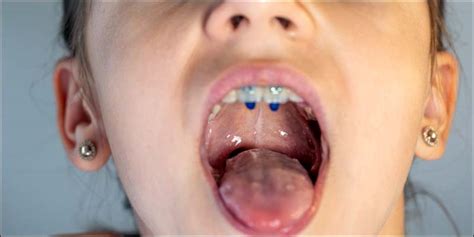 Understanding Hand Foot Mouth Disease: Symptoms & Prevention