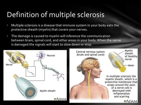 multiple sclerosis powerpoint    id