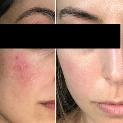 Rosacea Transformation Photos | The Rosacea Method Successes