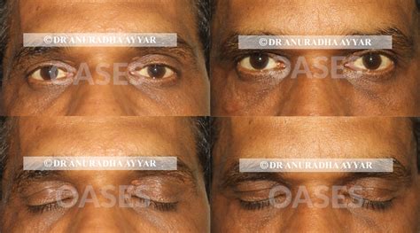 OASES Eye Care Center - Dr. Anuradha Ayyar