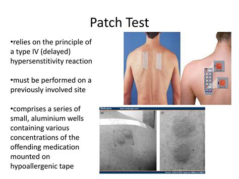 patch test powerpoint    id