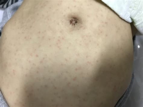 Pintinhas Vermelhas No Corpo Do Bebê O Que Pode Ser - Pintinhas vermelhas na pele! | BabyCenter