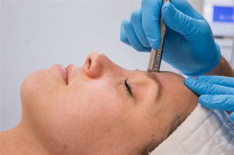 Microneedling Vs. Microdermabrasion - La Chelé