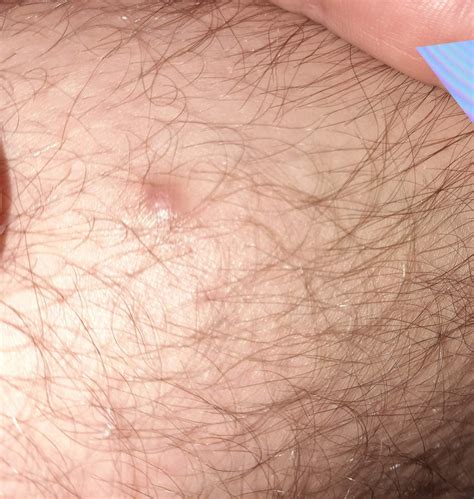 Lump on leg doesn't go away for years : r/Dermatology