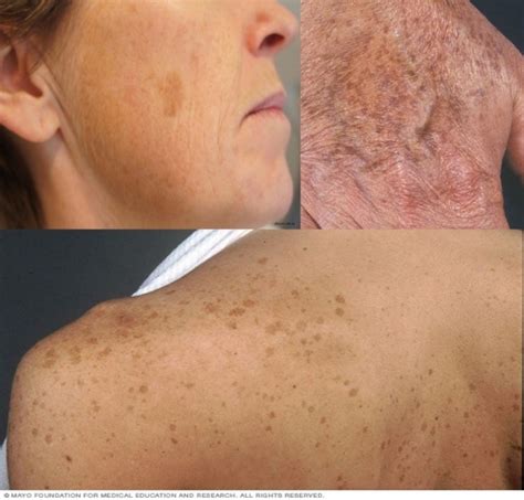 Age spots removal - Laser Skincare and Tattoo Removal by TrustedInkAway LLC