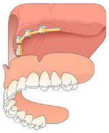 Dental Implant Treatment for the Full Upper Arch