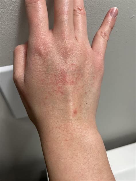 Rashes on my hands : r/Accutane