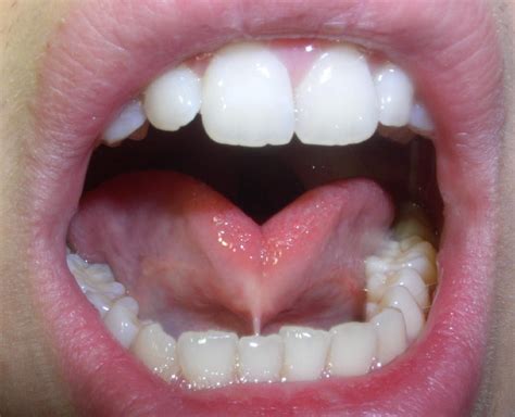 Three Videos of Laser Lingual Frenectomy Procedures | Oral Answers