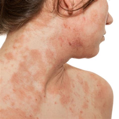 18 Common Skin Rash Pictures - How to ID Skin Rash Symptoms