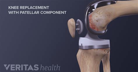 What to Expect After Knee Replacement