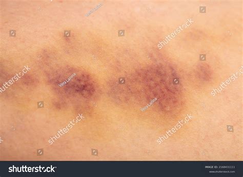 bruises  human body severe bruise stock photo  shutterstock