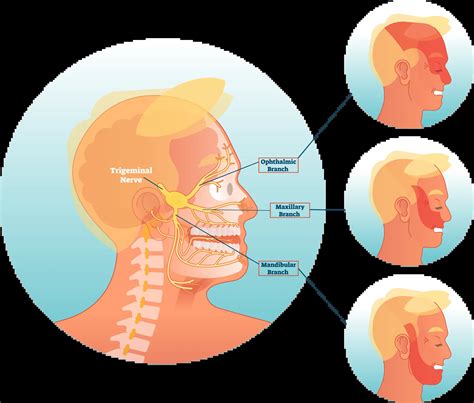 Trigeminal Neuralgia Treatment | TMJ & Sleep Therapy Centre of Temecula