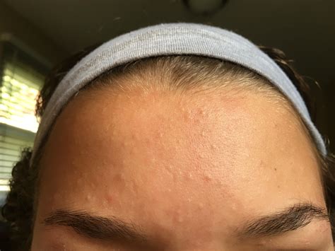 how to get rid of bumps on forehead 7