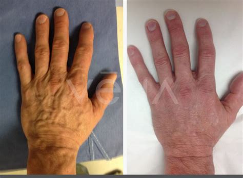 Vena | hand veins