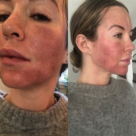 fractional laser artofit