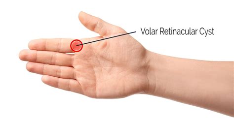 Ganglion Cysts Of The Wrist And Hand Dr Richard Meyer - vrogue.co