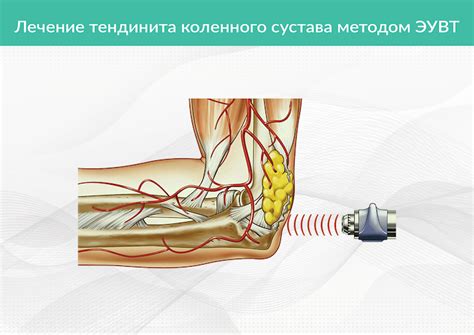 ᐈ Лечение тендинита в Москве ~【Клиника Традиция】