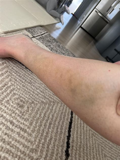 Calf bruising and pain unexplained : r/AskDocs