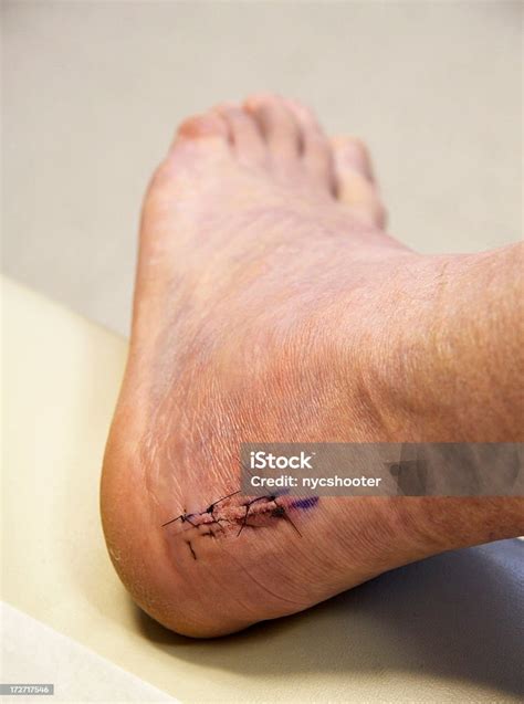 Foot Surgery Achilles Heel Stock Photo - Download Image Now - Achilles Tendon, Ankle, Close-up ...