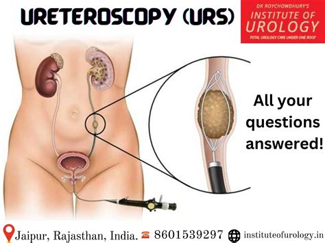 Ureteroscopic Stone Removal