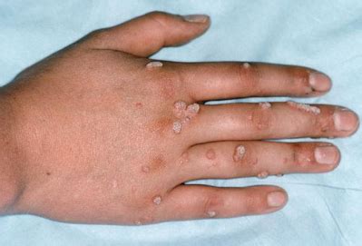 kutil gejala penyebab diagnosis  pengobatan
