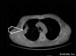 The New York Times > Health > Image > Lung Mass, Right Lung - CT Scan