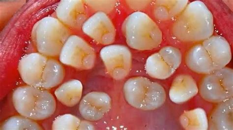 hyperdontia medizzy