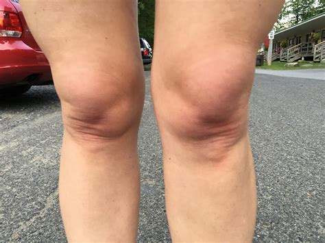 Knee Locking Hypermobility at Shantell Wilkinson blog