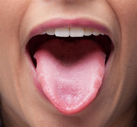 Small Tongue Disease at Jo Perez blog