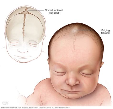 Encephalitis Disease Reference Guide - Drugs.com