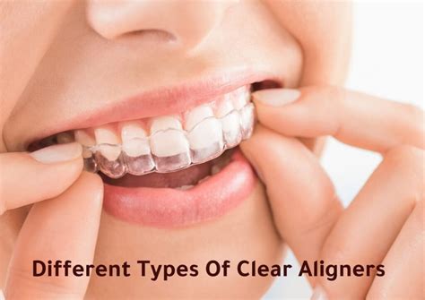 types  clear aligners
