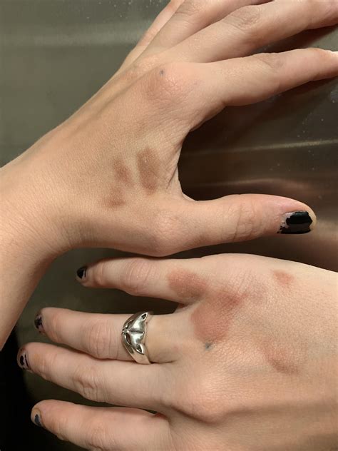 What are these dark spots on my hands? : r/SkincareAddicts