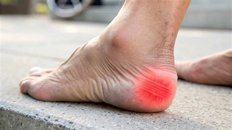 Heel Spur Treatment in Southern California | Causes, Symptoms & Relief