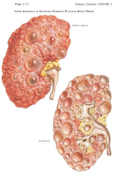 POLYCYSTIC KIDNEY DISEASE - pediagenosis