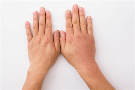 mengatasi jari bengkak sesuai penyebabnya  sehat