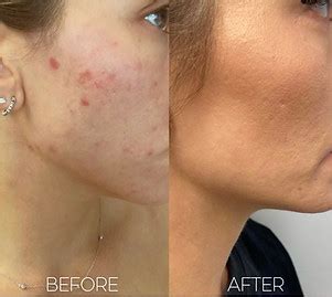 BEFORE & AFTER | The Calgary ACNE Clinic