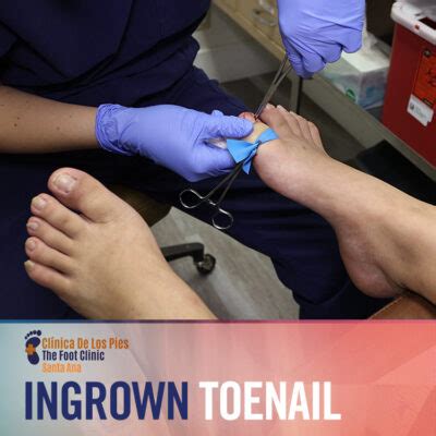 Ingrown Toenail - The Foot Clinic Santa Ana