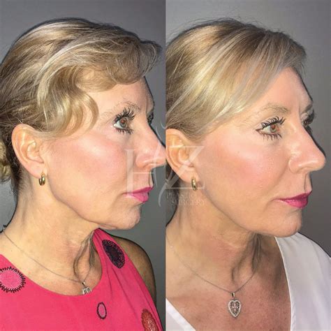 face lift   hz plastic surgery sagging skin face