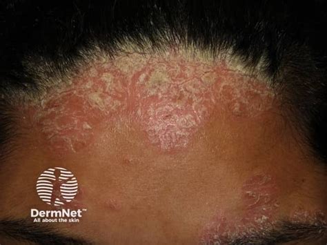 scalp psoriasis images dermnet