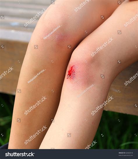 Scraped Knee Stock Photo 82060918 | Shutterstock