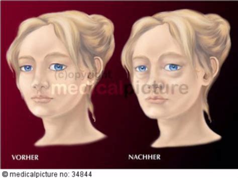 Facial Edema Pictures – Telegraph