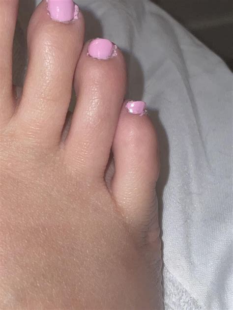 Is this maybe a bunion or a callus? : r/bunions