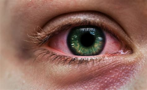 herpes simplex eye infections  symptoms treatment