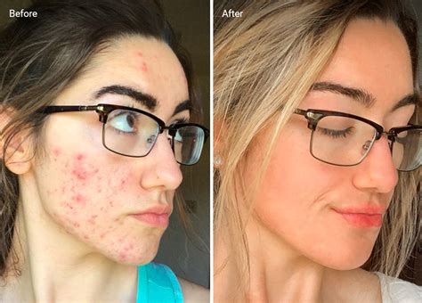 Accutane for Acne: How to Use It, Safety, Side Effects and More