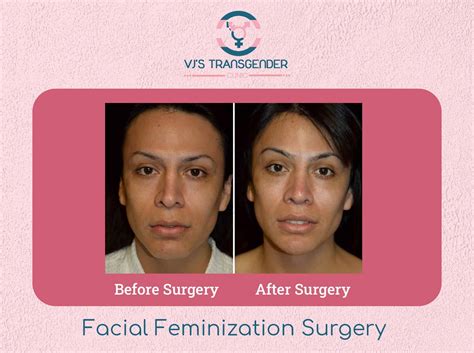 Male to Female Surgery Results with 100% Success Ratio | VJ’s
