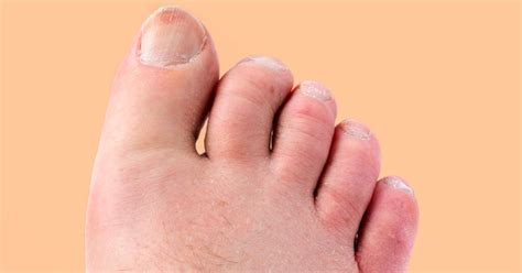 Psoriatic Arthritis in Your Toes: Pictures, Symptoms, and Treatment