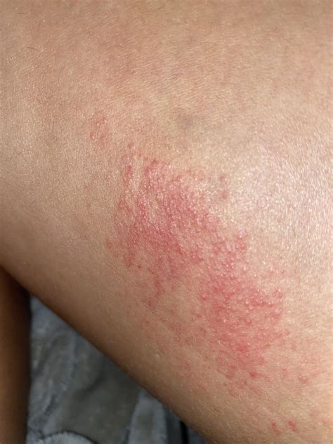 Rash. What is this caused by? Itchy, red, raised bumps. Upper left